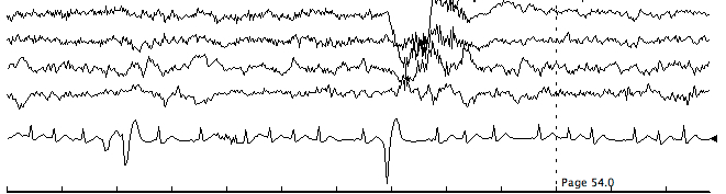 EEG record 2
